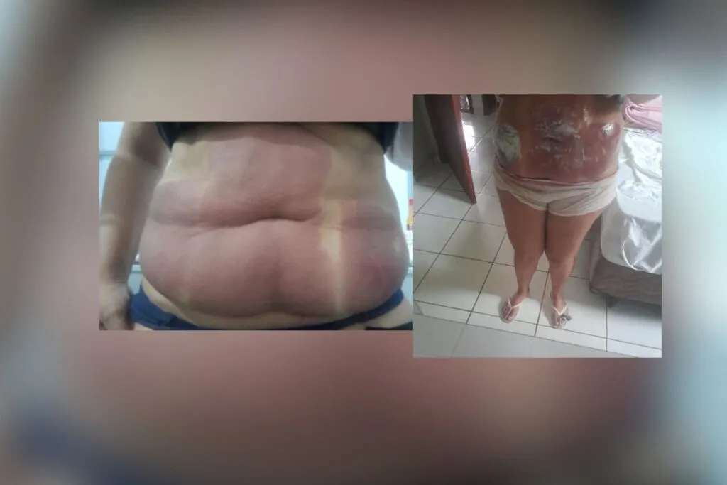 Mulher com queimaduras de 2º grau na região da barriga, após procedimento estético (Foto: Arquivo pessoal)