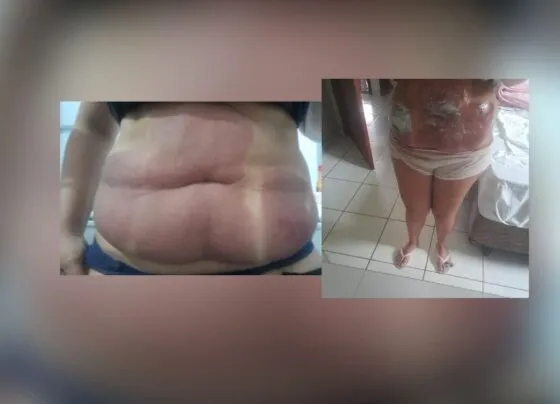 Mulher com queimaduras de 2º grau na região da barriga, após procedimento estético (Foto: Arquivo pessoal)